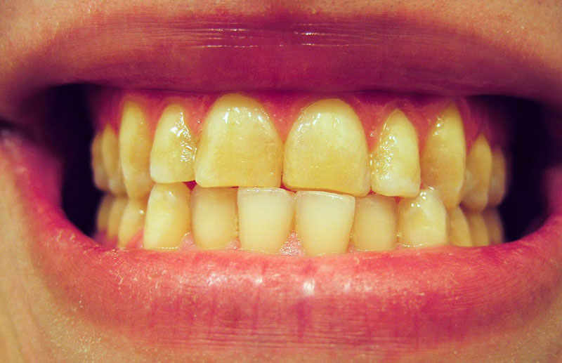 Come evitare l’ingiallimento e lo scolorimento dei denti?
